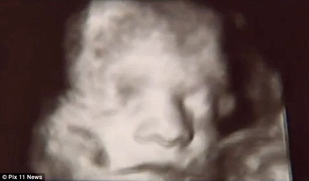 Sonography Image of the Baby